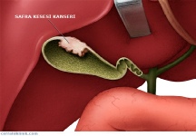 SAFRA KESESİ KANSERLERİ